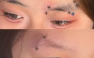 赤峰眉钉穿孔医院电话是多少号